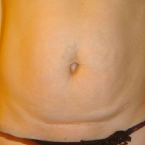 Tratamiento Exilis